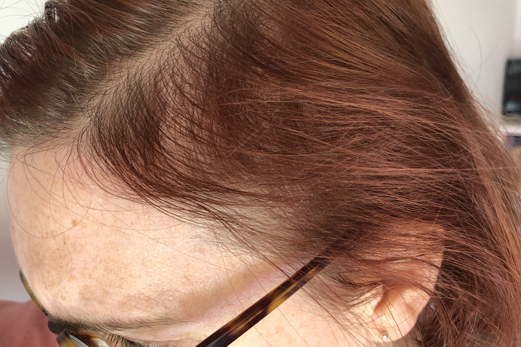 Recovering from hair loss caused by telogen effluvium -